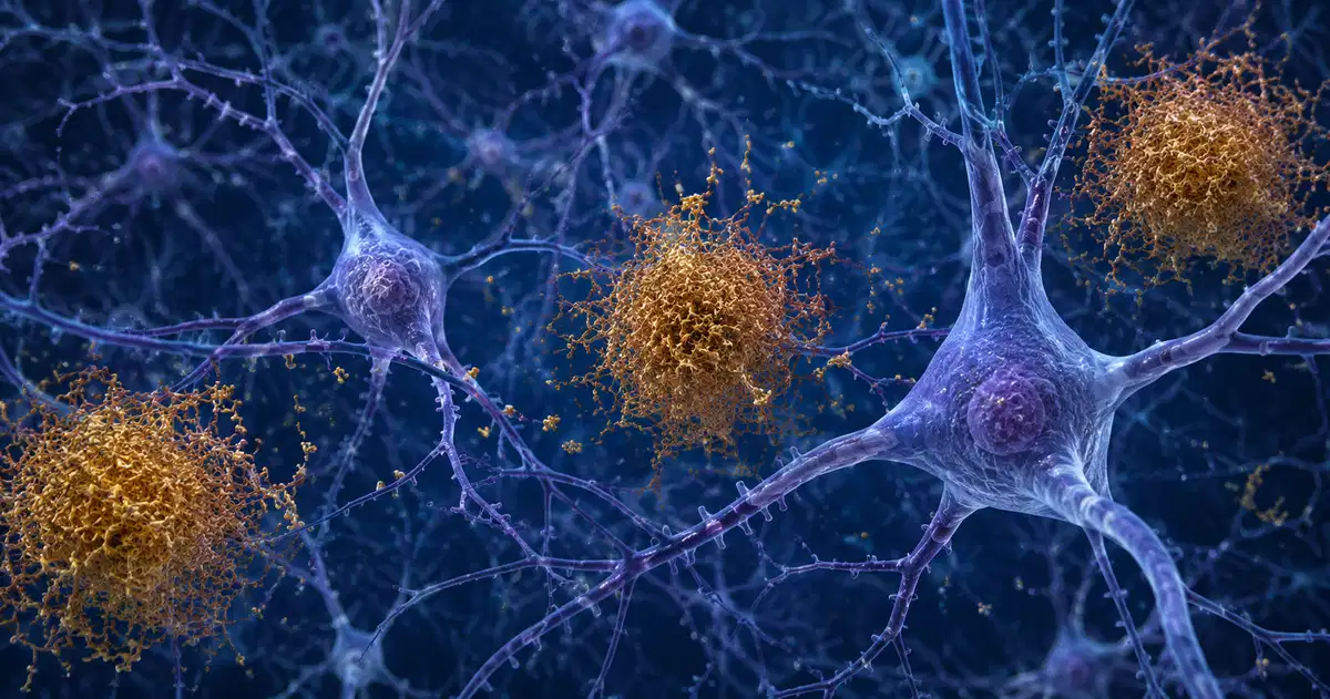 Ilustración de placas de amiloide beta, en ámbar, acumuladas entre las neuronas del tejido cerebral