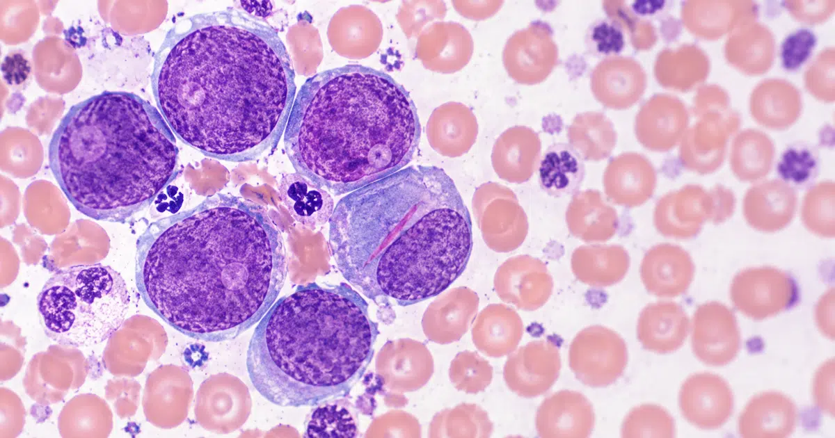 Imagen al microscopio de un frotis de sangre teñido con células blancas grandes e inmaduras de núcleo violeta entre glóbulos rojos rosados